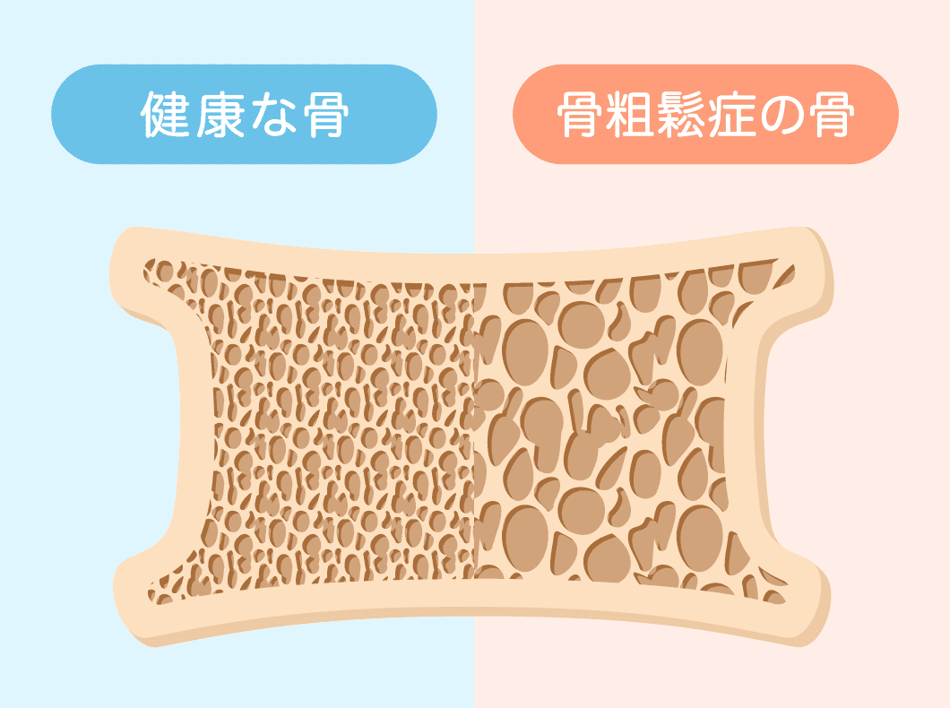 骨粗しょう症の主な治療法