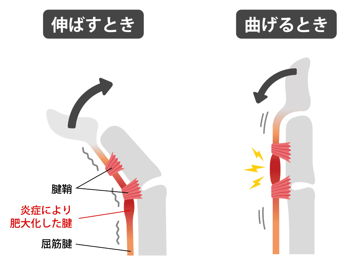 切らない』ばね指の日帰り手術